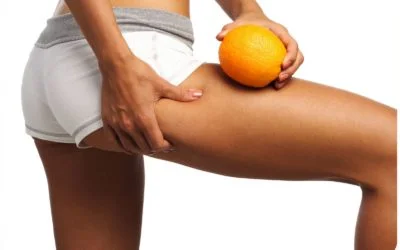 Celulite tem cura? Veja tratamentos e dicas para melhorá-la