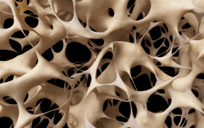 Osteoporose – Causas, sintomas e tratamento