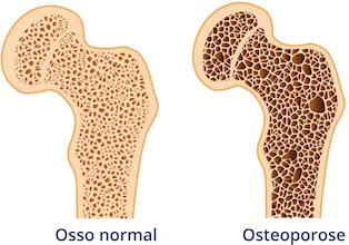 osteoporose -comparacao