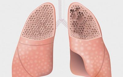 Saiba o que é enfisema pulmonar, doença provocada em geral pelo tabaco